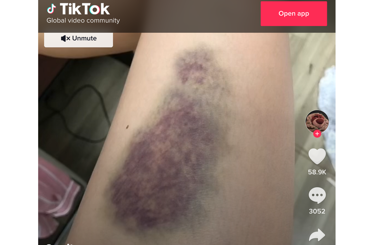 Sebuah video yang menyebut memar di tubuh sebagai ciri darah rendah, viral di media sosial TikTok.
