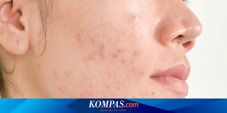 Mengapa Jerawat Selalu Muncul Di Pipi Sebelah Kanan Quora