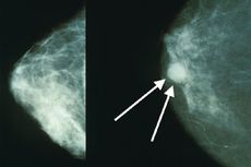 Deteksi Kanker Payudara, Pemeriksaan Apa Sih yang Paling Tepat?