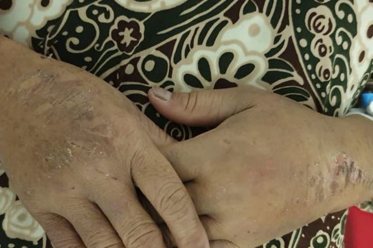 Tangan Sulasih binti Sukiran Sadli, seorang pekerja Indonesia yang diduga menjadi korban penyiksaan di Arab Saudi.