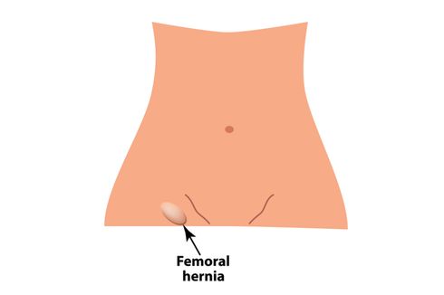 Hernia Femoral