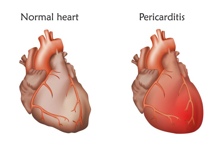 ilustrasi perikarditis