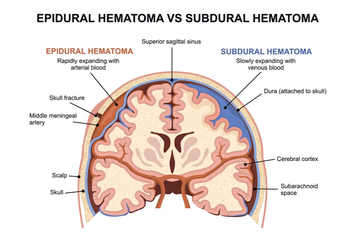 Ilustrasi epidural hematoma vs subdural hematoma