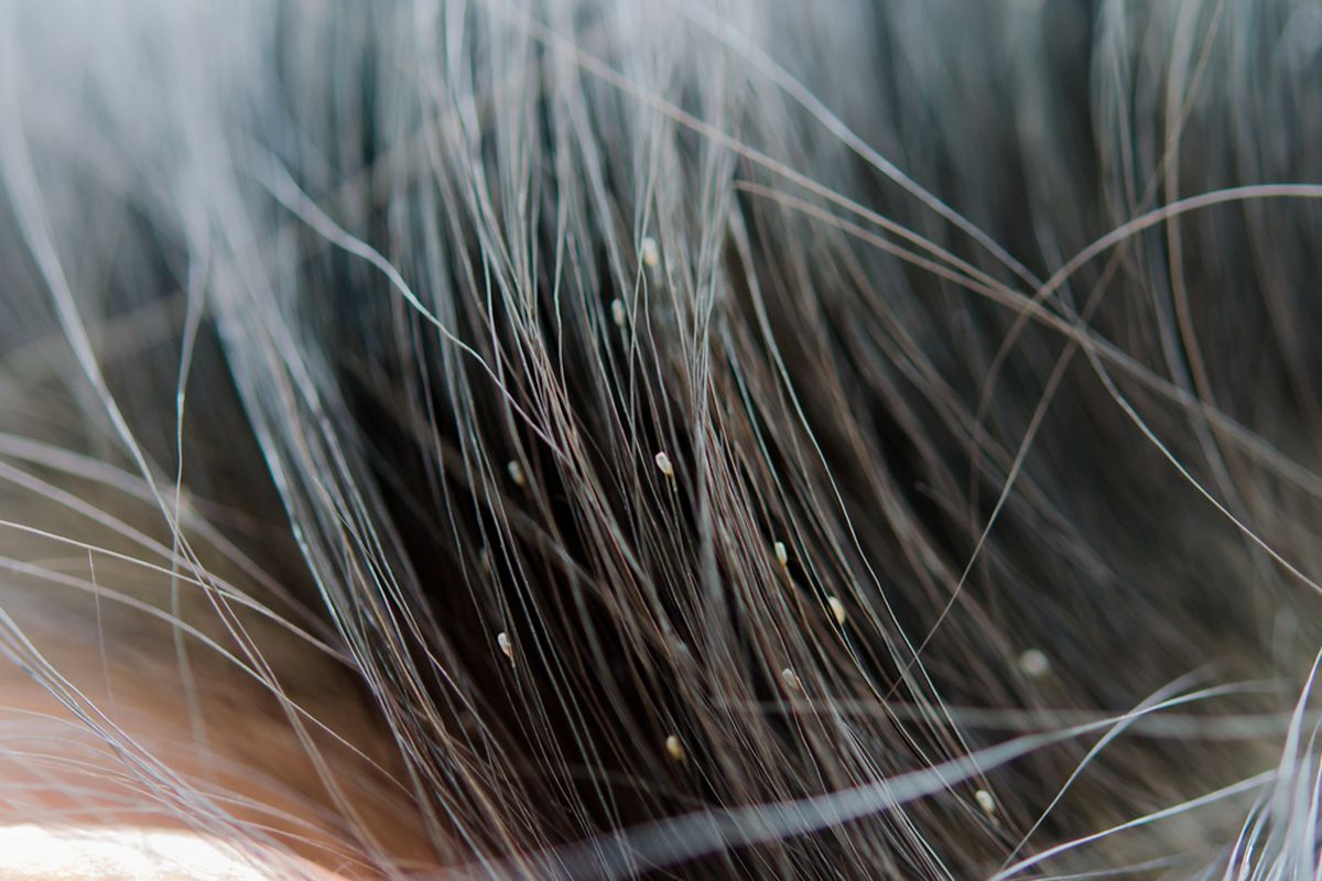 Ada beberapa cara menghilangkan kutu rambut yang dapat dicoba, termasuk melalui perawatan rumahan.