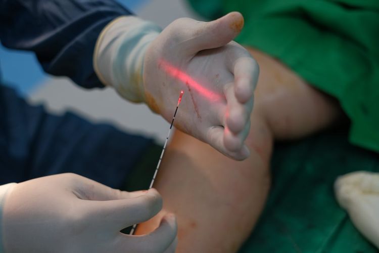 Metode Cyro Laser & Cryo Sclerotherapy (CLaCS) tersedia di klinik Indonesia Vein Center Jakarta.
