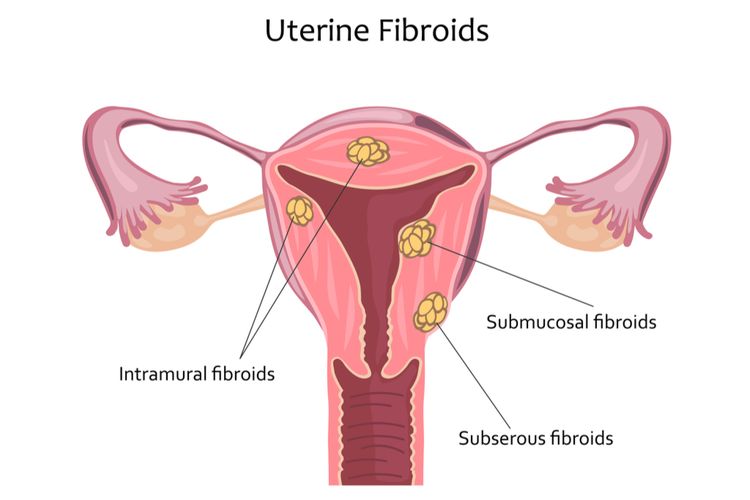 Ilustrasi fibroid rahim