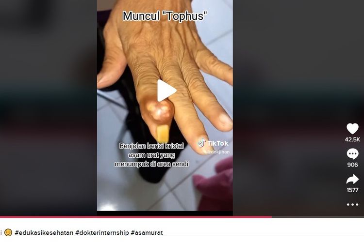 Unggahan video tentang tofi asam urat.