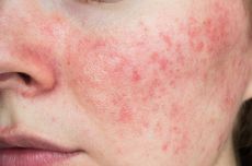 Apakah Rosacea Menular? Simak Penjelasan Berikut…