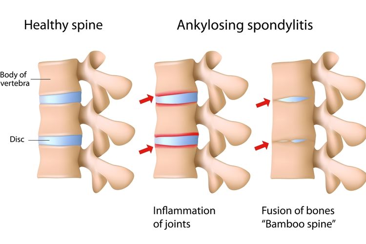 Ilustrasi Ankylosing Spondylitis