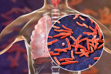 Apakah Penyakit Tuberkulosis Mematikan? Ini Kata Pakar…