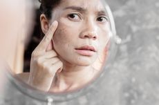 Apakah Okronosis akibat Krim Abal-Abal Bisa Hilang dengan Skincare?