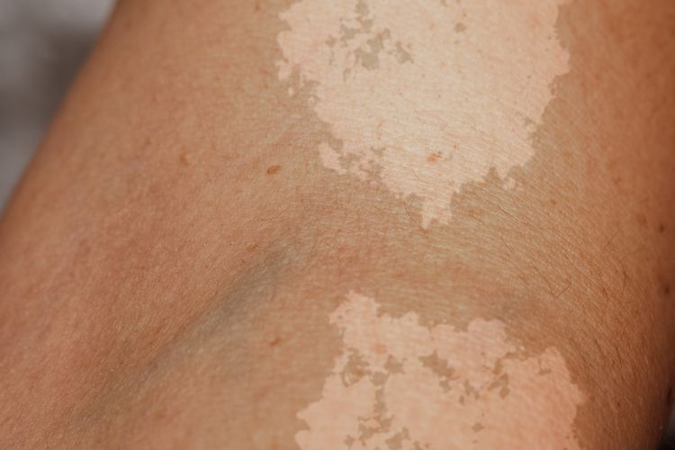 Gambar lengan orang yang menderita panu, infeksi jamur malassezia globosa, yang menyebabkan bercak perubahan warna kulit.
