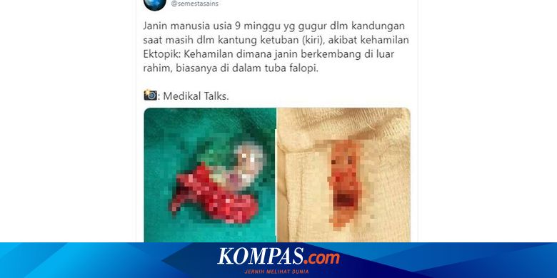 Twit Viral Janin Berusia 9 Minggu Yang Gugur Karena Hamil Ektopik Apa Itu Halaman All Kompas Com
