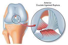 Cedera Ligamen Lutut Anterior 