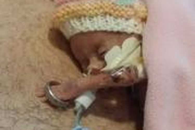 Tangan Mollie Perrin muat di cincin kawin ayahnya. Mollie lahir prematur dengan berat tak sampai 1 kilogram.