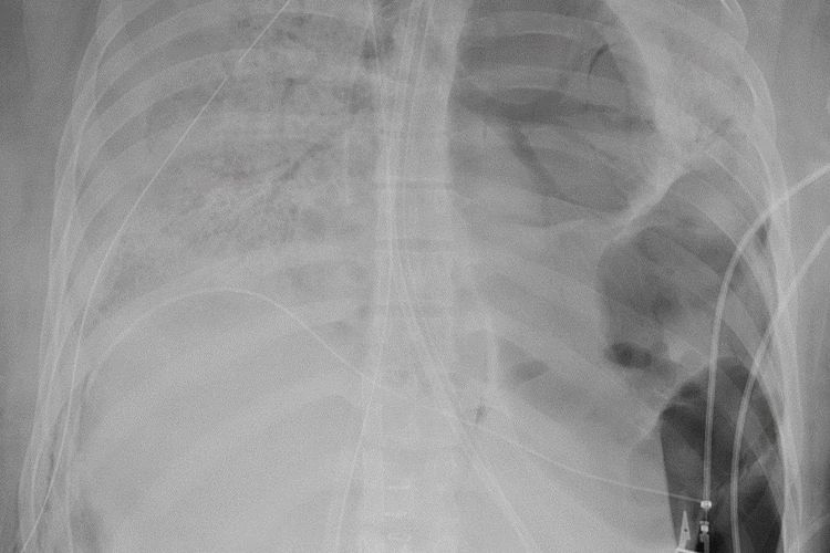 Rontgen paru-paru dari pasien Covid-19 sebelum menerima transplantasi paru-paru. FOto rontgen menunjukkan kerusakan parah pada paru-parunya.
