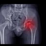 Penyakit Legg-Calve-Perthes