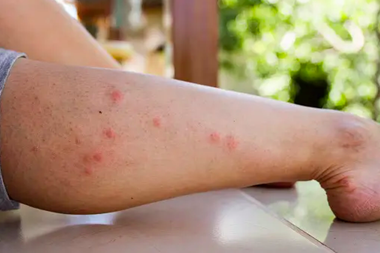 Ilustrasi gatal akibat gigitan nyamuk
