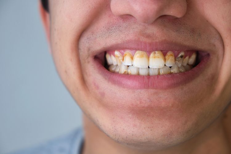 Plak dan karang gigi bisa menumpuk dan menyebabkan penyakit yang berbahaya.