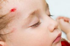Waspadai Cedera Kepala pada Anak yang Memiliki Efek Jangka Panjang
