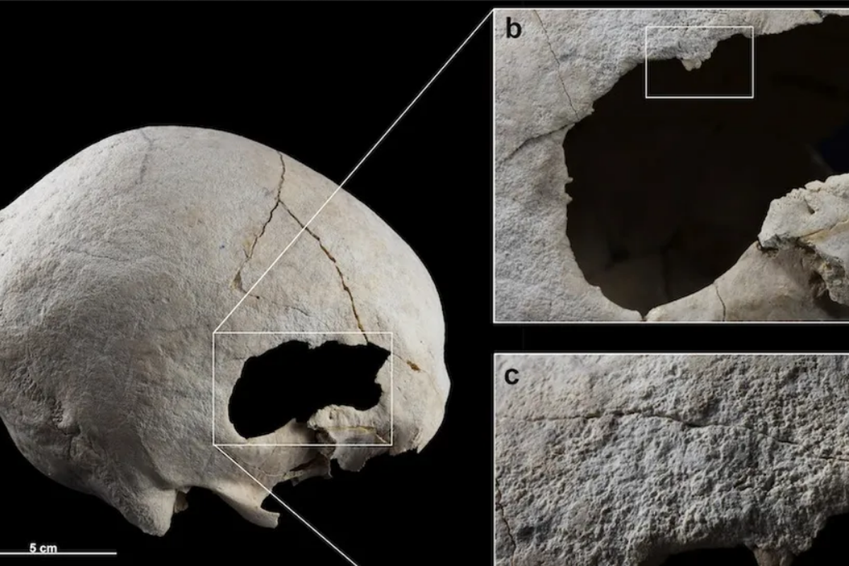 Bukti operasi di kepala yang dilakukan pada perempuan 4.500 tahun yang lalu