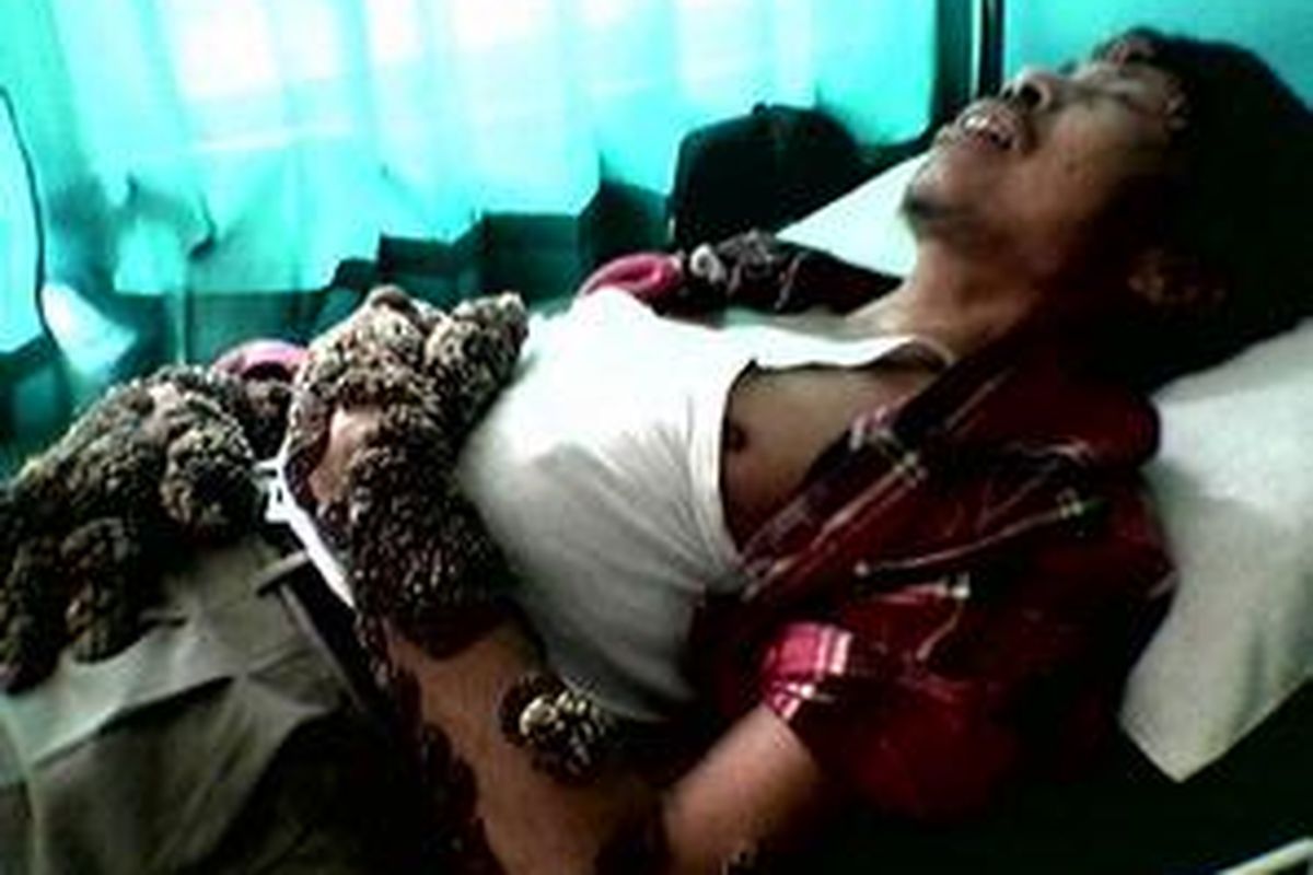 Zaenal (35) pasien dengan kutil yang tumbuh menyebar dan berkembang di tubuh berbaring di RS Detasemen Kesehatan Tentara (DKT) Lampung. Jumat (25/4). Zaenal dipindah oleh keluarga dari RSUD Abdul Moeloek ke RS DKT untuk mendapatkan pengobatan yang lebih cepat setelah sebelumnya tidak mendapat perawatan dari dokter spesialis.