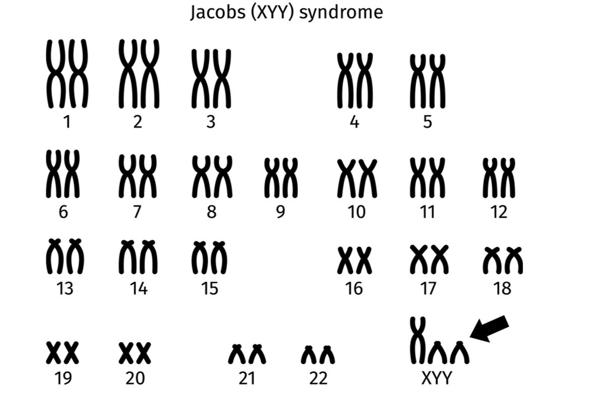 Ilustrasi sindrom Jacob