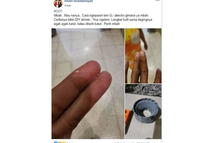 Sebuah unggahan bernarasikan jari tangan seseorang terkena lem hingga merekat satu sama lain, viral di media sosial.
