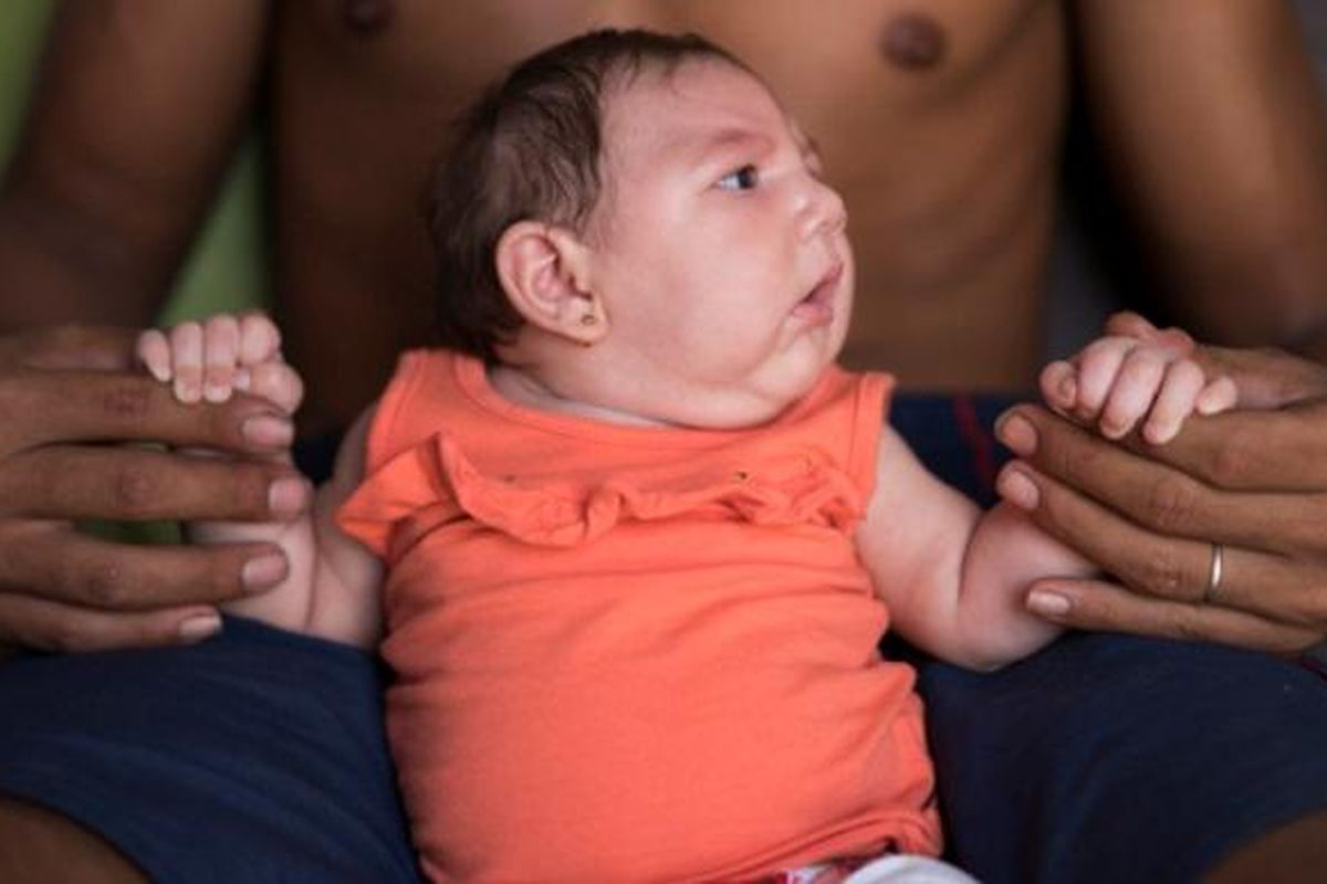 Bayi Luzia asal Brasil menderita mikrosefali karena diduga terinfeksi virus ZIka yang ditularkan melalui nyamuk.