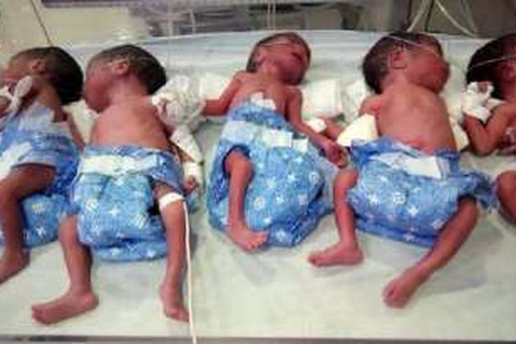 Ibunya mengira hanya satu bayi, ternyata bayi perempuan kembar lima. Mereka lahir prematur saat usia kehamilan ibu baru 26 minggu atau 6,5 bulan dari kehamilan normal 9 bulan.