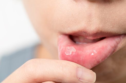 6 Penyebab Kanker Mulut yang Perlu Diwaspadai