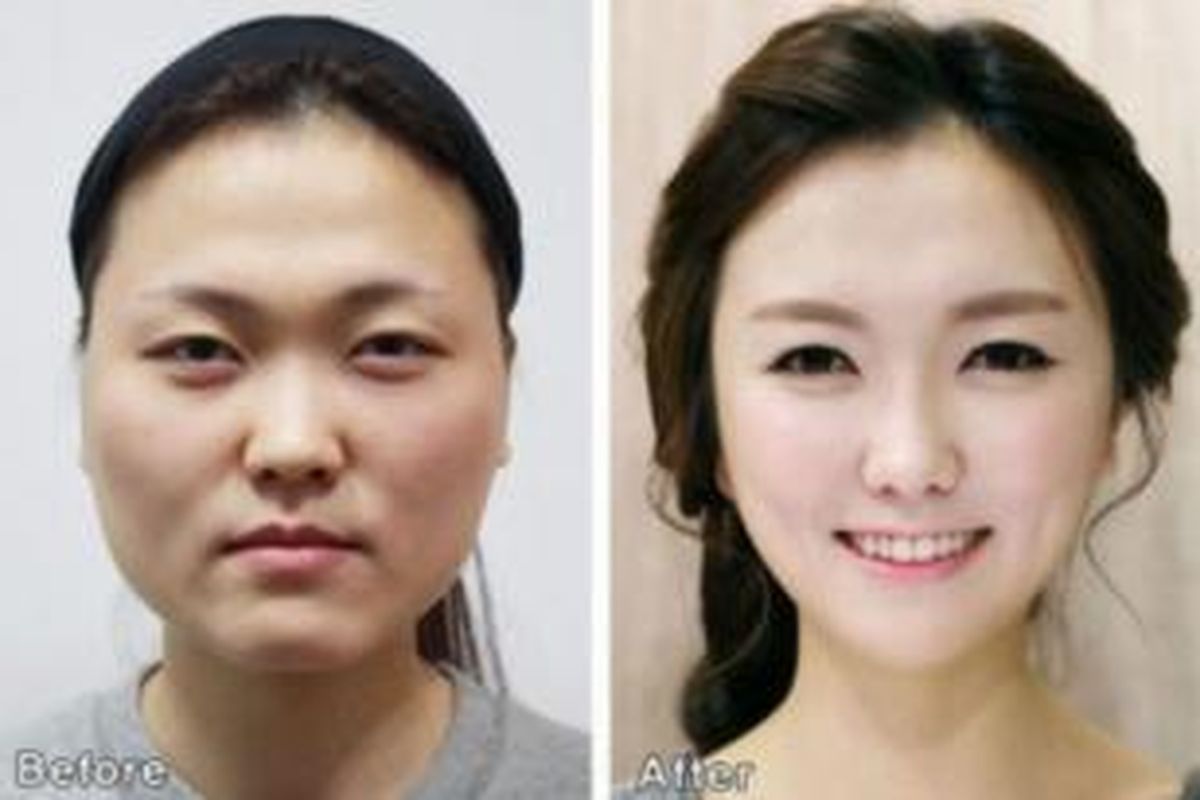 Para dokter bedah plastik Korea Selatan sangat hebat mengubah wajah pasiennya seperti perempuan dalam foto ini. Bandingkan wajahnya sebelum dan sesudah menjalani operasi plastik.