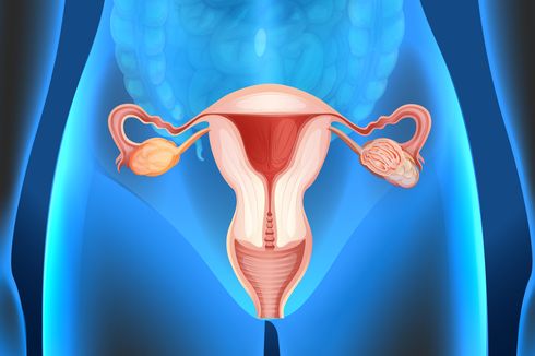 Gejala Kista Ovarium dan Cara Mendeteksinya