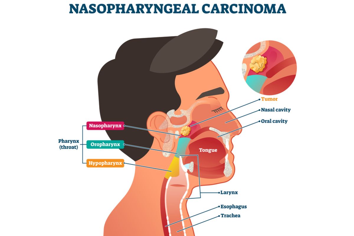 Ilustrasi karsinoma nasofaring