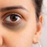 9 Obat Alami untuk Menghilangkan Lingkaran Hitam di Bawah Mata