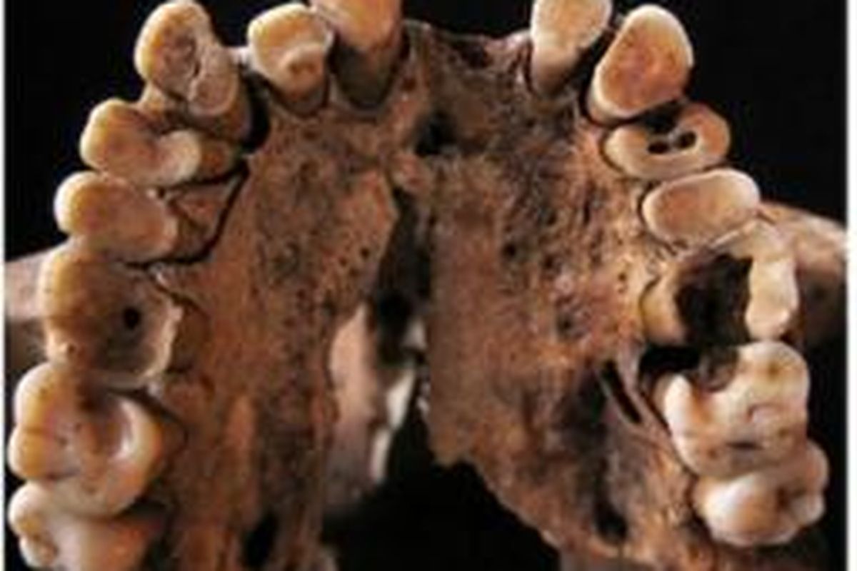 Gigi keropos ternyata sudah menjadi masalah manusia sejak zaman batu.