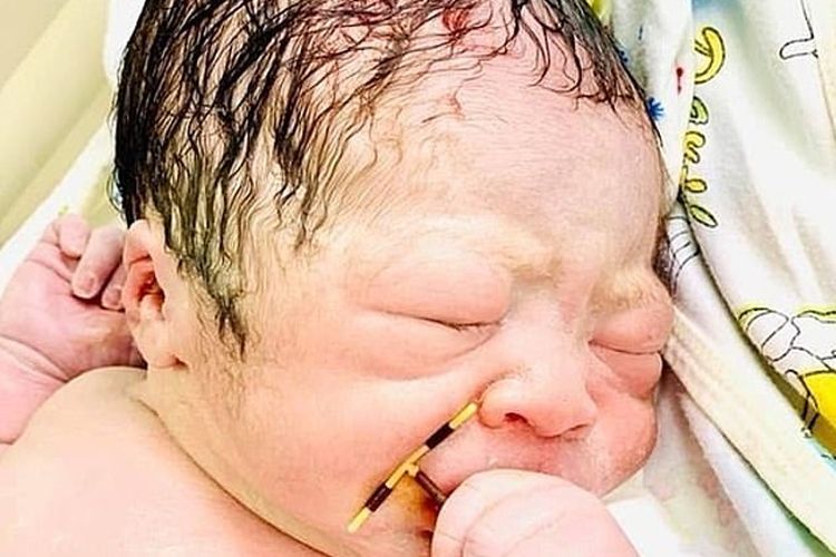 Bayi laki-laki di Vietnam ini lahir dengan posisi tangan memegang alat kontrasepsi sang ibu yang ada di dalam rahim.