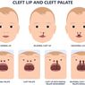 Anak Alami Bibir Sumbing, Apa Tindakan Medisnya?