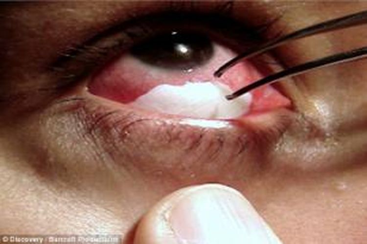 Mata wanita asal Brasil, Laura Pons (35) mengeluarkan plak putih keras seperti kristal saat menangis atau mengeluarkan air mata.