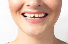 6 Penyebab Gigi Patah dan Cara Mengatasinya