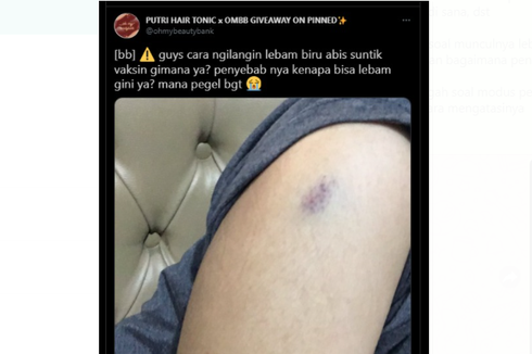 Muncul Memar di Lengan Setelah Vaksinasi, Apa Penyebabnya?