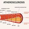 Aterosklerosis