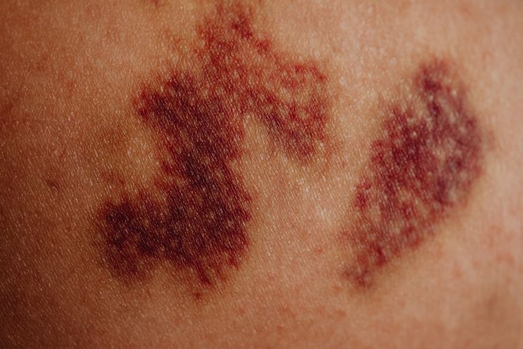 Ilustrasi kulit lebam akibat anemia. (Pexels: Karolina Grabowska)