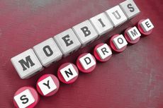 Sindrom Moebius