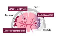 Pendarahan Subarachnoid