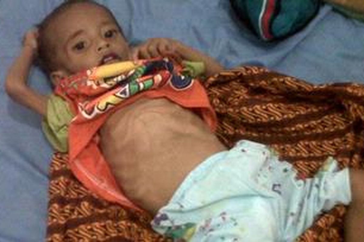 Filsafih tengah di rawat di RSUD Morotai karena menderita gizi buruk.