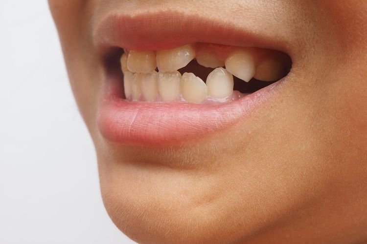 Penyebab gigi berlebih belum diketahui secara pasti, namun beberapa kondisi kesehatan tertentu akan meningkatkan risikonya.