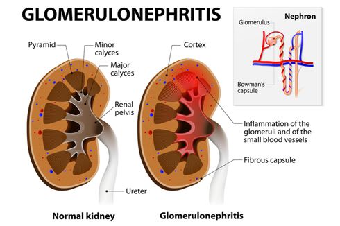 Glomerulonefritis