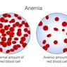 Anemia Aplastik: Gejala, Penyebab, Cara Mengatasi