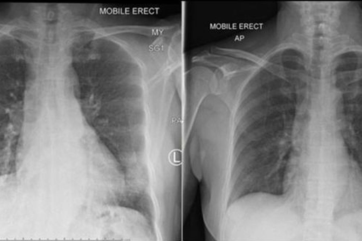 Hasil rontgen memperlihatkan paru-paru pasien bersih setelah sel-sel imun berperang melawan virus corona. Foto kiri pada hari kelima perawatan, foto kanan pada hari ke-10. 
